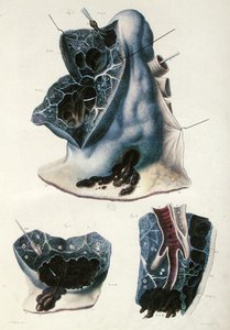 Jean Cruveilhier (1791-1874) 1828-42年の「Anatomie Pathologique du Corps Humain」より肺の疾患（彩色彫刻） 作： Antoine Chazal