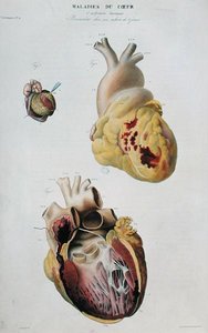 心臓病を描いたプレート。86歳の女性の心臓の自然破裂（図1）と生後6日目の赤ちゃんの心膜炎（図2）、パリで出版されたJean Cruveilhier（1791-1874）の「Anatomie pathologique du corps humain」より。 作： Antoine Chazal