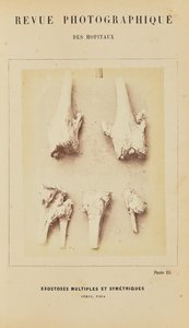 多発性対称性外骨腫、大腿骨、脛骨 作： Arthur de Montmeja