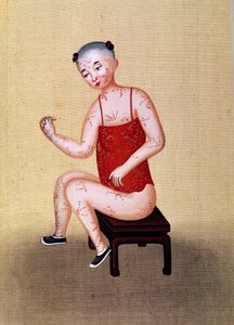 天然痘の子供（紙にトイレ）