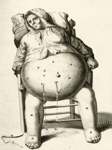 膿瘍からの液体の排出、Frederic Dekkersによる実践的な練習から治療法まで、1694年 作： Dutch School