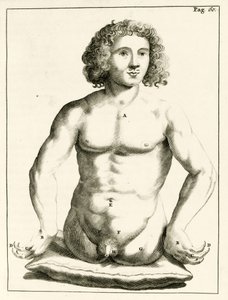 先天性先天性欠損症の例、Frederic Dekkersによる実践的な演習から治療法まで、1694年 作： Dutch School