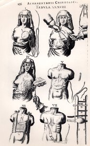 1672年にアムステルダムで出版されたJohannes Schultes（1595-1645）によるArmamentarii Chirurgiciによる乳がんの手術