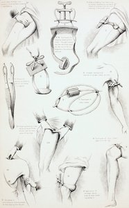 出血を止める方法、c.1890 作： English School
