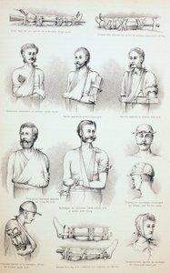 骨折の一時的な治療、1890年頃 作： English School