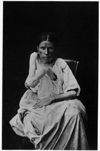 片麻痺のてんかん患者の写真（「サルペトリエールの写真図像」BournevilleとP.Regnard、パリ 作： French Photographer