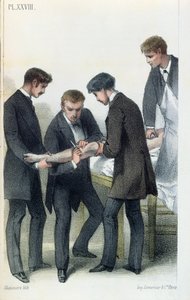 Jean-Baptiste-Leon Dubreuilによる医療マニュアルからの腕の切断、c.1850-60