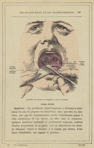 ブラシを使って扁桃腺に外用剤を塗布する（カラーリトグラフ