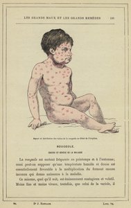 発疹の出始めの麻疹斑の出現と分布（カラーリトグラフ 作： French School
