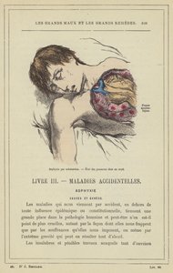 水没による窒息、溺れた人の肺の状態（カラーリトグラフ 作： French School