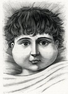 おたふく風邪をひいた子供（エングレービング）1888年 作： French School