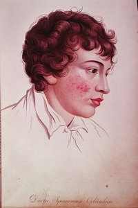 ジャン・ルイ・アリベール男爵（1768-1837）の「皮膚の病変に関する記述」からのドライパッチ 作： French School