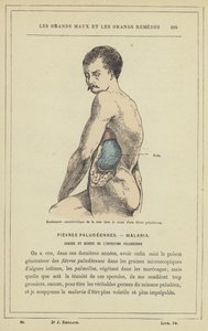 マラリア熱の経過で脾臓が特徴的に腫れる（カラーリトグラフ 作： French School