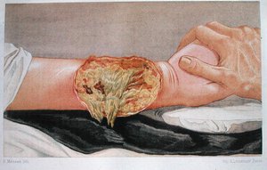 病院の壊疽、Edmund Delorme（1847-1929）の「Traite de Chirurgie de Guerre」より、F. Meheuxが彫刻。 作： French School