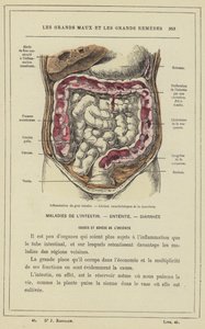 大腸の炎症、赤痢に特徴的な病変（カラーリトグラフ 作： French School
