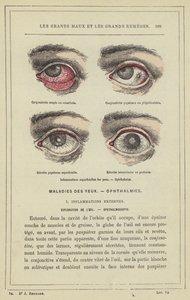 目の表面的な炎症、Ophthalmia（カラーリトグラフ 作： French School