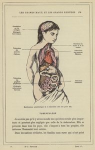 若い女性に見られる結核の特徴的な症状（カラーリトグラフ 作： French School