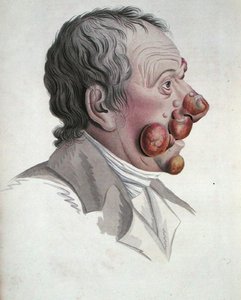 Mycosis Fongoide、Baron Jean Louis Alibert (1768-1837)の著書より 1838年（彩色されたエングレービング）