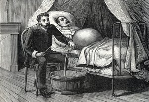 進行した肝硬変の患者、穿刺を行う医師（彫刻）1888年 作： French School
