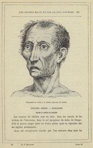 コレラの窒息期における患者の人相（カラーリトグラフ 作： French School