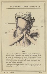 腕の出血時のランセットの位置（カラーリトグラフ 作： French School