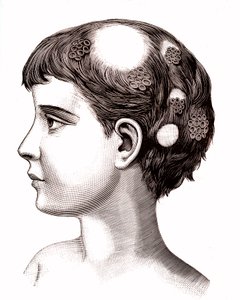 子供の白癬1887年（エングレーヴィング） 作： French School