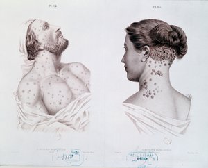 医学書c.1850-60からの男性と女性の梅毒の症状 作： French School