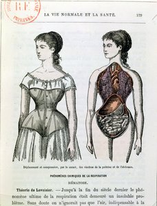 コルセットの有害な影響、ジュール・レンゲード博士によるラ・ヴィ・ノーマルとラ・サンテのイラスト（b.1841）c.1880 作： French School