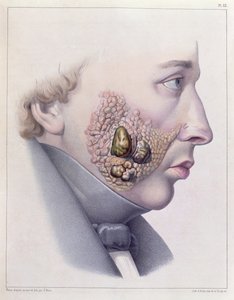 性的疾患の顔の症状、フィリップ・リコード（1800-89）1851によるTraite Complet des Maladies Veneriennesから 作： French School