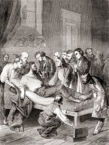 1846年、アメリカの歯科医ウィリアム・トーマス・グリーン・モートンが、外科用麻酔薬として吸入エーテルを使用することを初めて公開した様子（1870年頃に出版された「Les Merveilles de la Science」より 作： French School