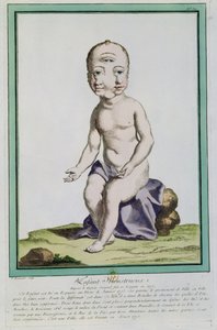 変形した頭を持つ子供、「レエカルトデラネイチャー」、パリ、1775年 作： Genevieve Regnault de Nangis