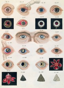 フリードリッヒ・アウグスト・フォン・アンモン（1799-1861）1838による、先天性の眼の異常の説明、病気の臨床的表現および人間の目の盲目な欠陥から 作： German School