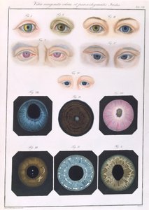フリードリッヒ・アウグスト・フォン・アンモン（1799-1861）1838による、先天性の眼の異常の説明、病気の臨床的表現および人間の目の盲目な欠陥から 作： German School