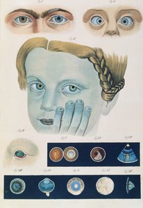 フリードリッヒ・アウグスト・フォン・アンモン（1799-1861）1838による、先天性の眼の異常の説明、疾患の臨床的表現および人間の目の失明の欠陥から 作： German School