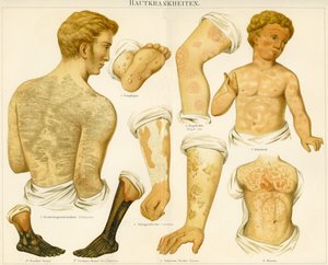 皮膚疾患、1890年頃 作： German School
