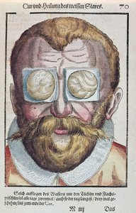 眼の状態の治療、1583年にドレスデンで出版されたGeorg Bartisch（1535-1636）によるOphthalmodouleiaから（カラー木版画） 作： German School