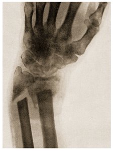 骨折した手首のX線c.1890 作： German School