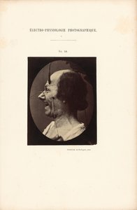 写真電気生理学、図39 作： Guillaume Benjamin Duchenne