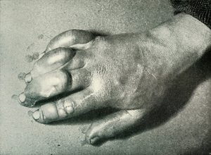 アトキンソンズフロストビッテンハンド、1911年7月5日、1913年 作： Herbert Ponting