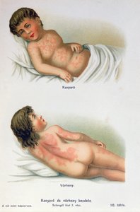 家族の医学書からのはしかと緋色の熱、1900年頃 作： Hungarian School