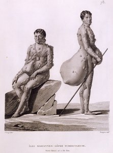 北マリアナ諸島：結核に苦しむ2人の男性、1825年にブルジョワによって彫刻された「航海Autour du Monde sur les Corvettes de L&39;Uranie 1817-20」から出版、1825年