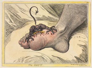 痛風、1799年。 作： James Gillray