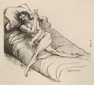 ヒステリーてんかん、発作、ゆがみ、イチジク。ボーンヴィルとP.レニャールによるパリの「Iconographie Photographique de La Salpetriere」から3、パリ、1876 作： Jean Francois Badoureau