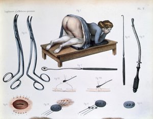 膀胱膣瘻の手術、Jean-Baptiste Marc Bourgery (1797-1849) 1866-67年の「Traite Complet de l