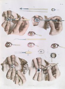 ジャン・バティスト・マルク・ブールジェリー（1797-1849）1866-67による「Traite Complet de l&39;Anatomie de l&39;Homme」の目、プレートの操作 作： Nicolas Henri Jacob