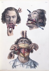 下顎の手術、ジャン・バティストマルクブールジェリー（1797〜1849）、1866〜67年の「Traite Complet de l&39;Anatomie de l&39;Homme」のプレート