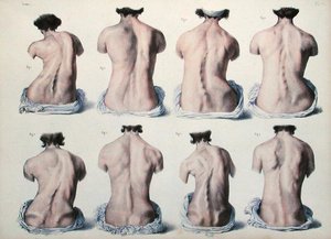 脊椎の変形、Jean-Baptiste Marc Bourgery (1797-1849) 1866-67年の「Traite Complet de l