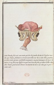 J.ロバート、1783年に彫刻されたアンジェリークマドリードアンブーリエデュクードレイ（1714-94）の本から子宮を腕で引いた赤ちゃんの断面図 作： P. Chapparre