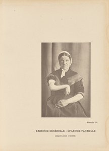 脳萎縮部分てんかん 右片麻痺 作： Paul Marie Léon Regnard