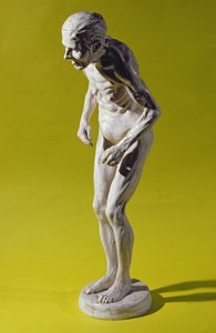 パーキンソン病（石膏）の女性像 作： Paul Marie Louis Pierre Richer